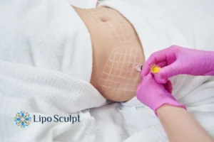 Are The Results From Aqualyx Permanent? 1 Do you want to know how long Aqualyx Thetford results last?