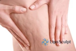 CoolSculpting for Legs: The Innovative Approach to Redefining Your Legs 5 Start your journey today book your coolsculpting treatment Thetford online today!